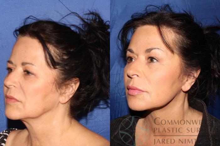 Before & After Facelift Case 125 Right Oblique View in Lexington & London, KY