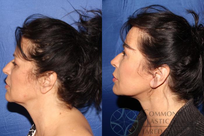 Before & After Facelift Case 125 Right Side View in Lexington & London, KY