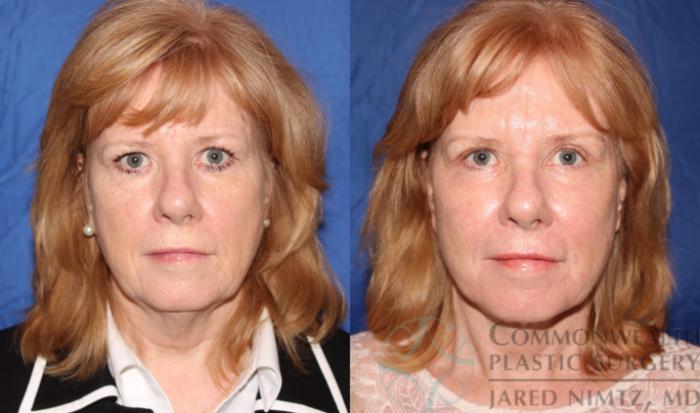Before & After Facial Fat Grafting Case 62 View #1 View in Lexington & London, KY