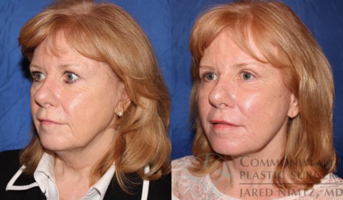 Before & After Eyelid Surgery Case 62 View #2 View in Lexington & London, KY