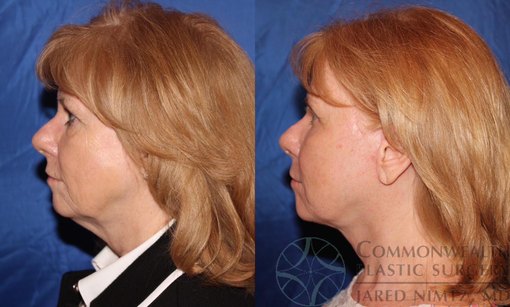 Before & After Facelift Case 62 View #3 View in Lexington & London, KY