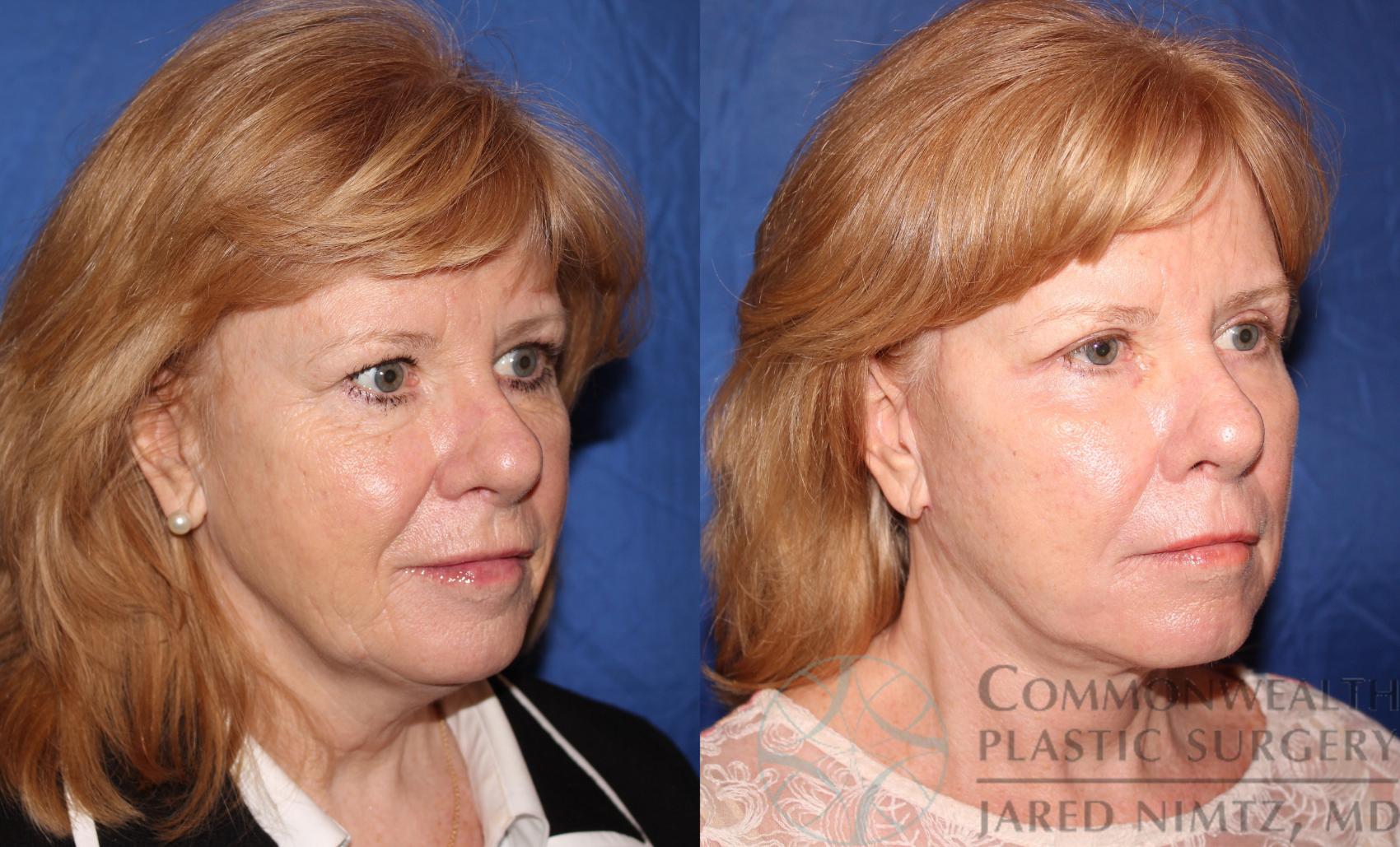 Before & After Facelift Case 62 View #4 View in Lexington & London, KY