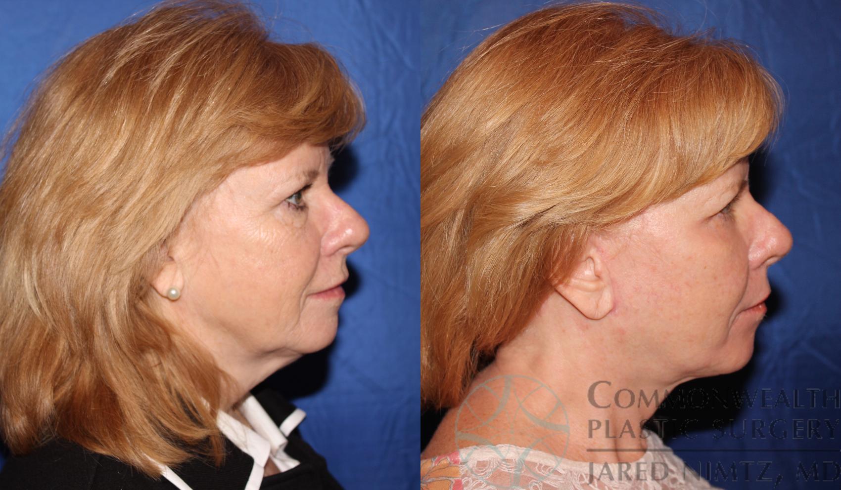 Before & After Facelift Case 62 View #5 View in Lexington & London, KY