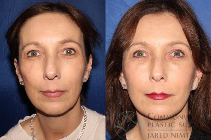 Before & After Facial Fat Grafting Case 129 Front View in Lexington & Lousiville, KY