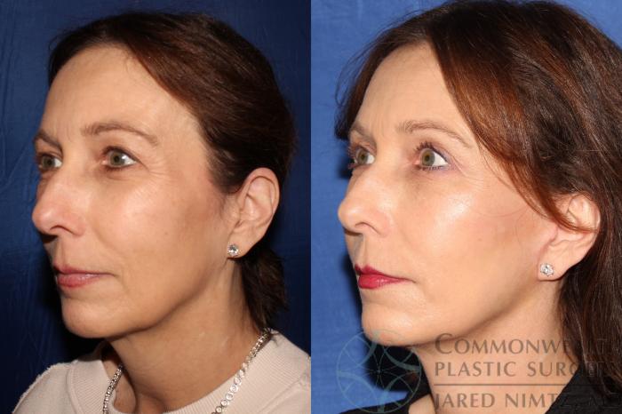 Before & After Facial Fat Grafting Case 129 Left Oblique View in Lexington & Lousiville, KY