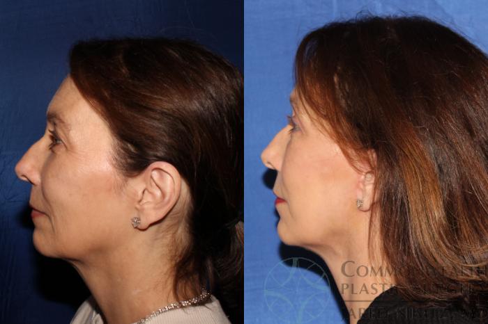 Before & After Facial Fat Grafting Case 129 Left Side View in Lexington & Lousiville, KY