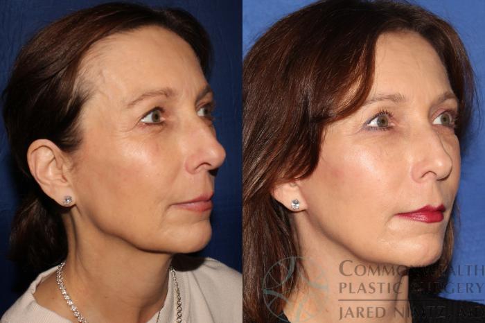 Before & After Facial Fat Grafting Case 129 Right Oblique View in Lexington & Lousiville, KY