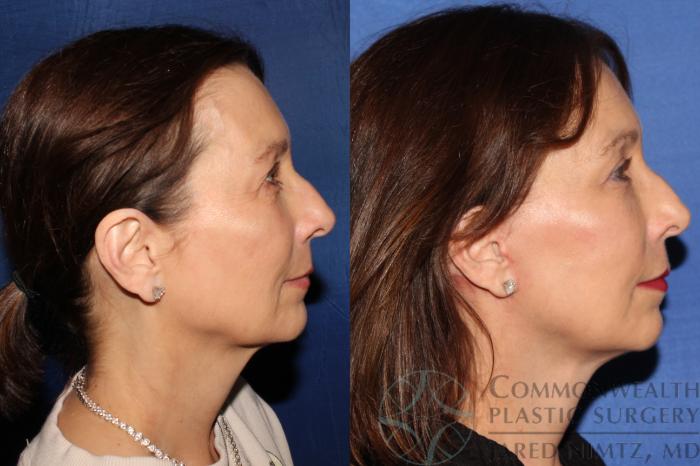 Before & After Facial Fat Grafting Case 129 Right Side View in Lexington & Lousiville, KY