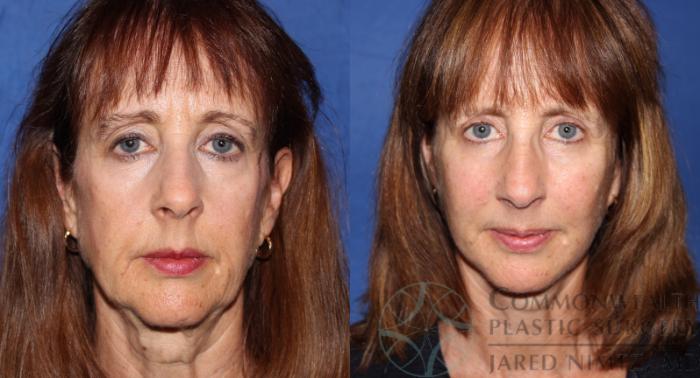 Before & After Facial Fat Grafting Case 64 View #1 View in Lexington & London, KY