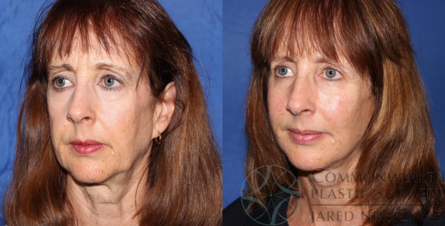Before & After Facial Fat Grafting Case 64 View #2 View in Lexington & London, KY