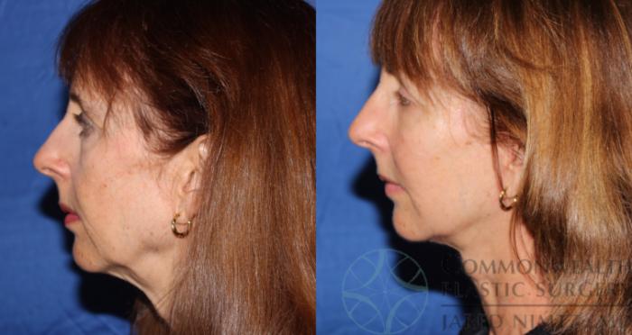 Before & After Facial Fat Grafting Case 64 View #3 View in Lexington & London, KY