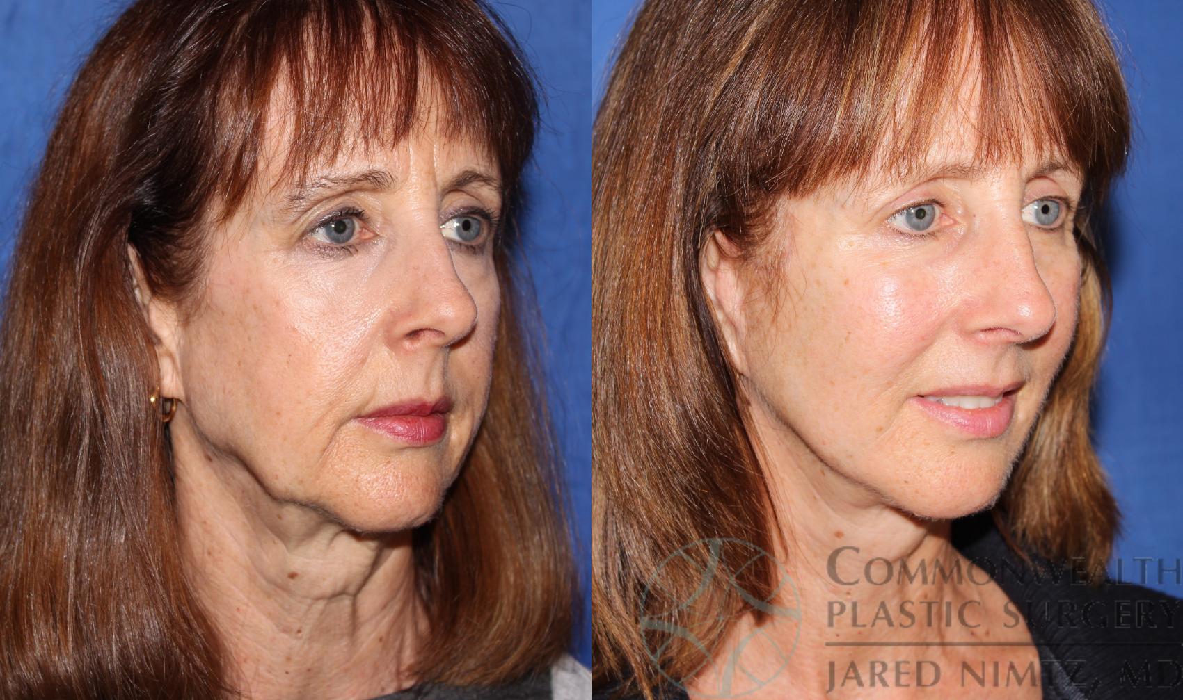 Before & After Facial Fat Grafting Case 64 View #4 View in Lexington & London, KY