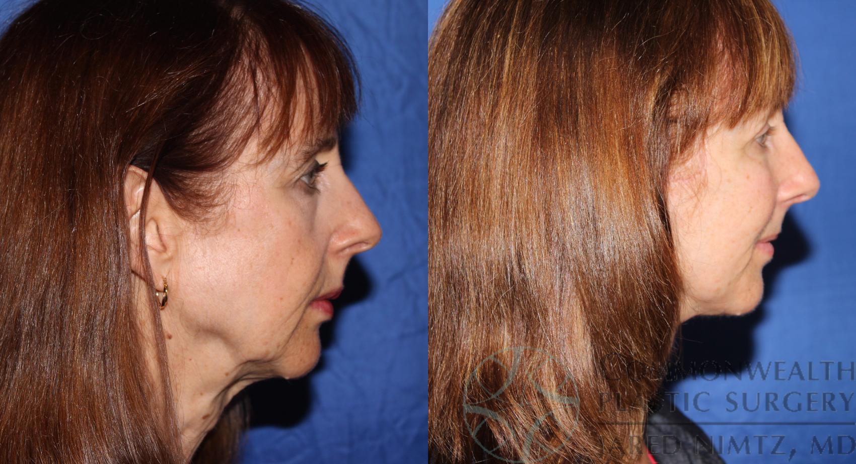Before & After Facial Fat Grafting Case 64 View #5 View in Lexington & London, KY