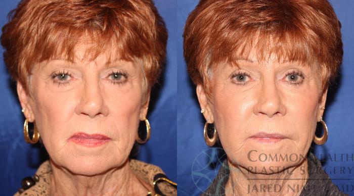 Before & After Facial Fat Grafting Case 68 View #1 View in Lexington & London, KY