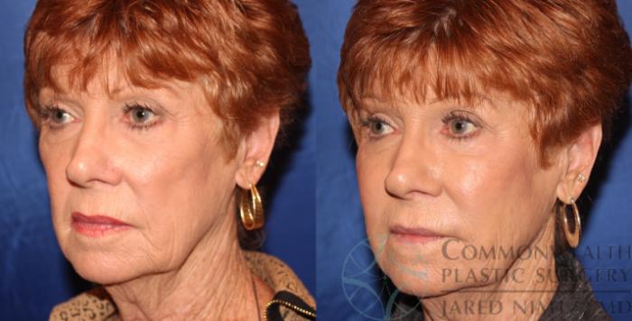 Before & After Facial Fat Grafting Case 68 View #2 View in Lexington & London, KY