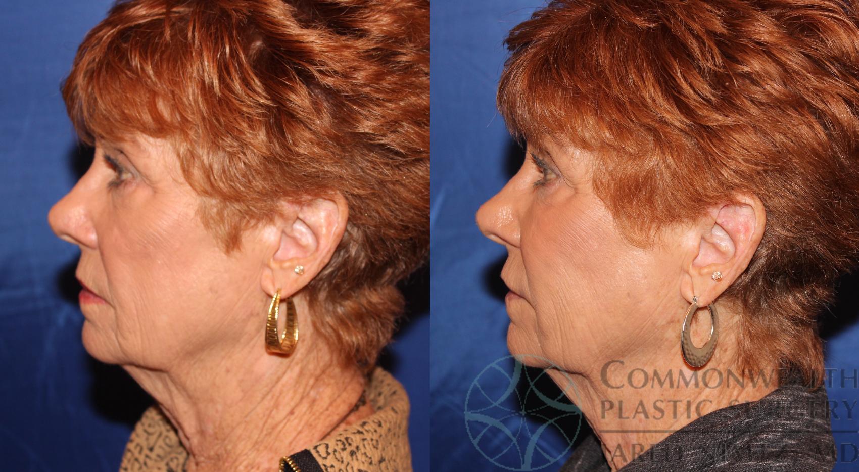 Facial Fat Grafting