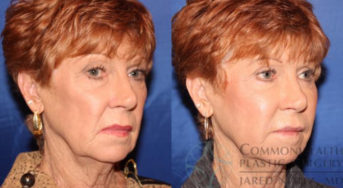 Before & After Facial Fat Grafting Case 68 View #4 View in Lexington & London, KY