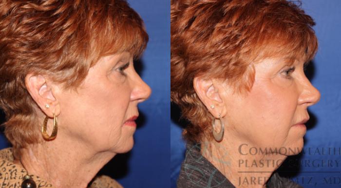 Before & After Facial Fat Grafting Case 68 View #5 View in Lexington & London, KY