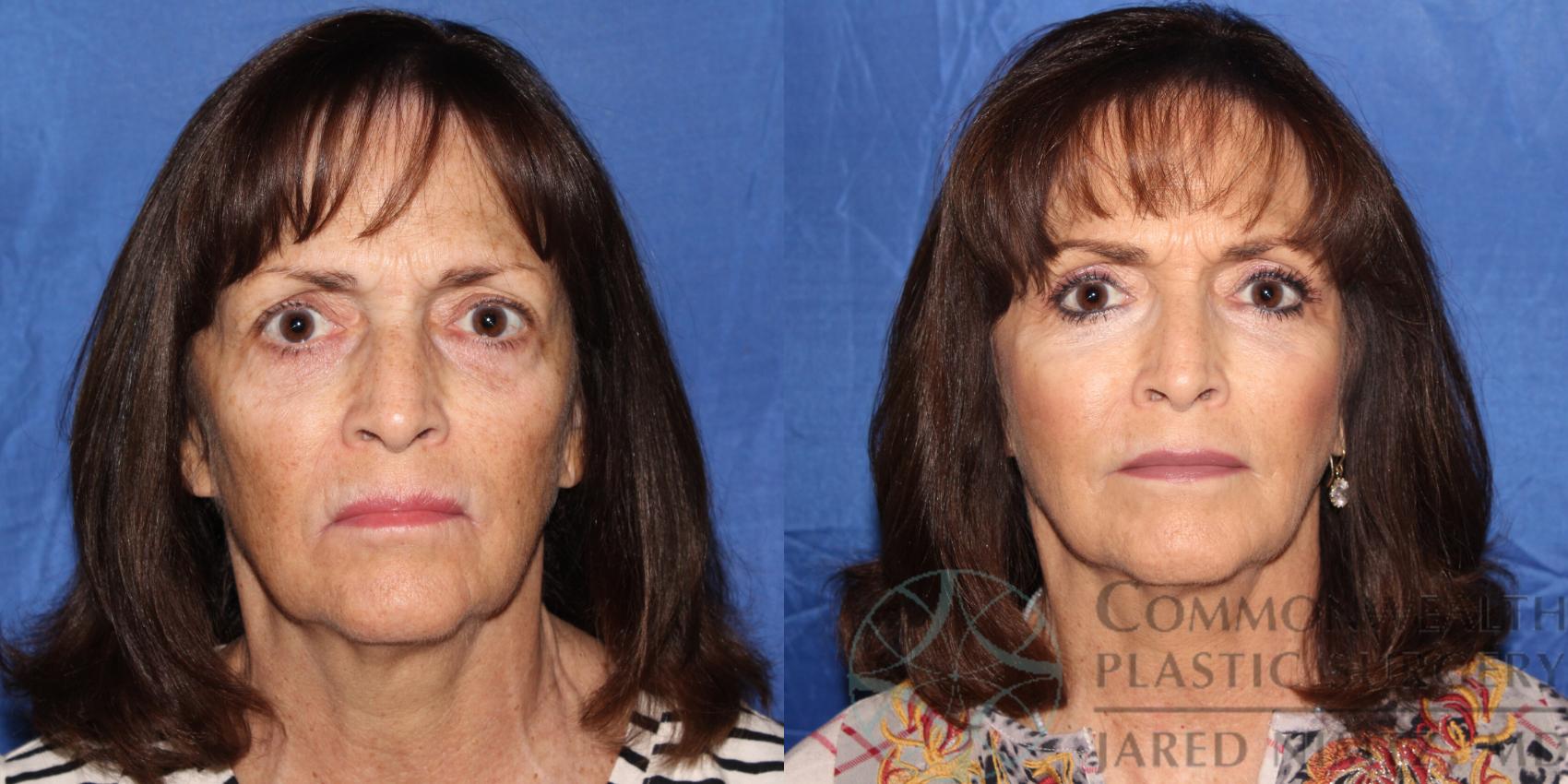Before & After Facial Fat Grafting Case 81 View #1 View in Lexington & London, KY