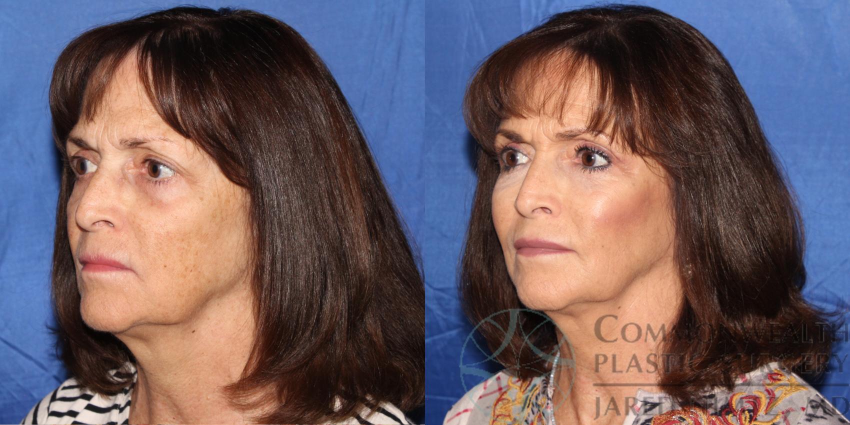 Before & After Facial Fat Grafting Case 81 View #2 View in Lexington & London, KY