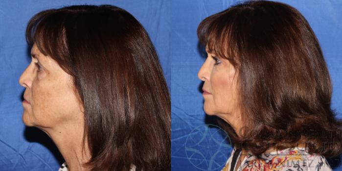 Before & After Facial Fat Grafting Case 81 View #3 View in Lexington & London, KY