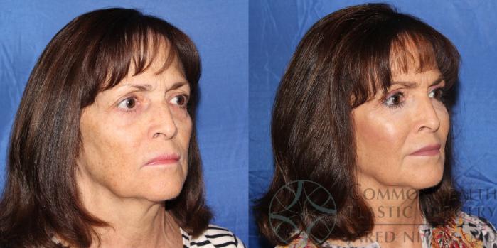 Before & After Facial Fat Grafting Case 81 View #4 View in Lexington & London, KY