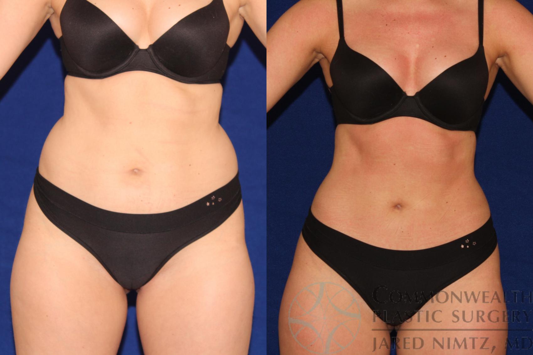 Before & After Liposuction Case 123 Front View in Lexington & London, KY