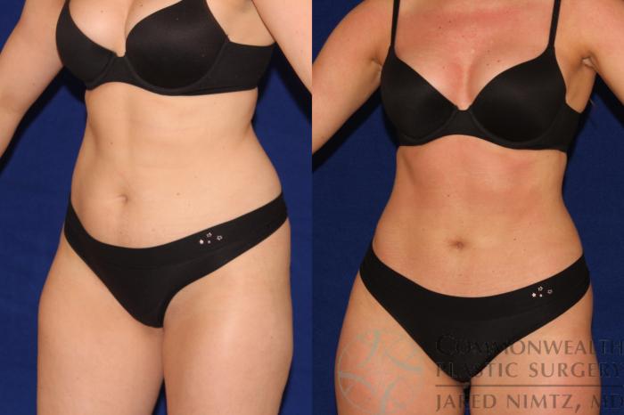 Before & After Liposuction Case 123 Left Oblique View in Lexington & London, KY