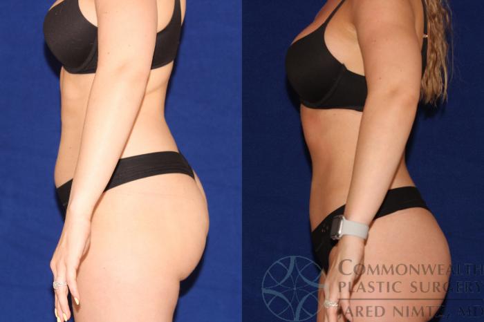 Before & After Liposuction Case 123 Left Side View in Lexington & London, KY