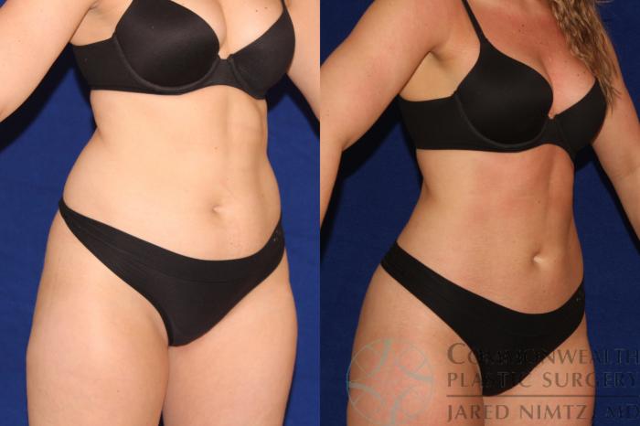 Before & After Liposuction Case 123 Right Oblique View in Lexington & London, KY