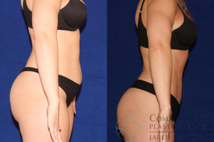 Before & After Liposuction Case 123 Right Side View in Lexington & London, KY