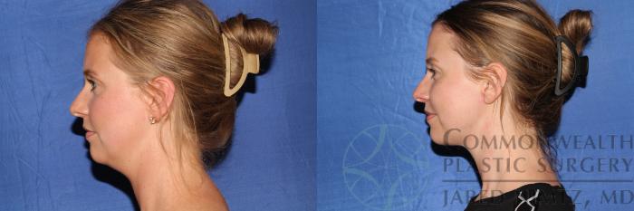 Before & After Liposuction Case 132 Left Side View in Lexington & Lousiville, KY
