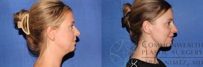 Before & After Liposuction Case 132 Right Side View in Lexington & Lousiville, KY