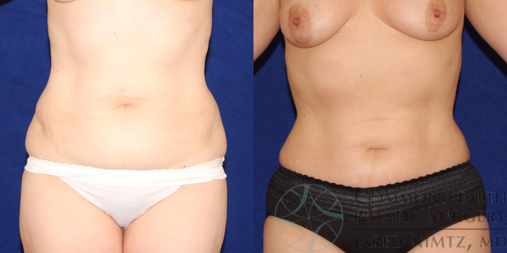 Liposuction Case 88 Before & After View #1 | Lexington & London, KY | Commonwealth Plastic Surgery