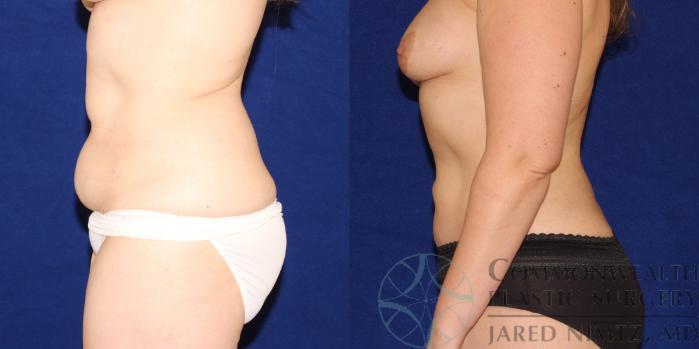 Before & After Liposuction Case 88 View #2 View in Lexington & London, KY