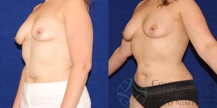 Before & After Liposuction Case 88 View #3 View in Lexington & London, KY