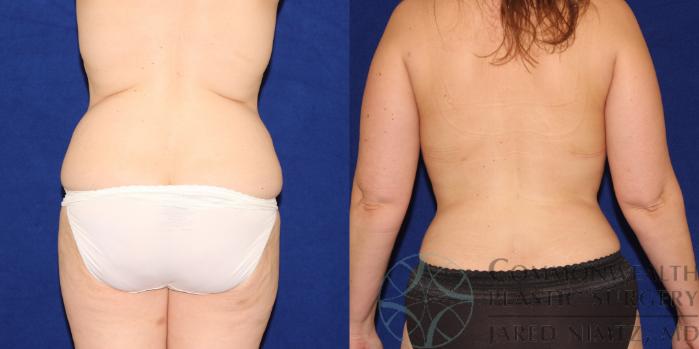 Before & After Liposuction Case 88 View #4 View in Lexington & London, KY