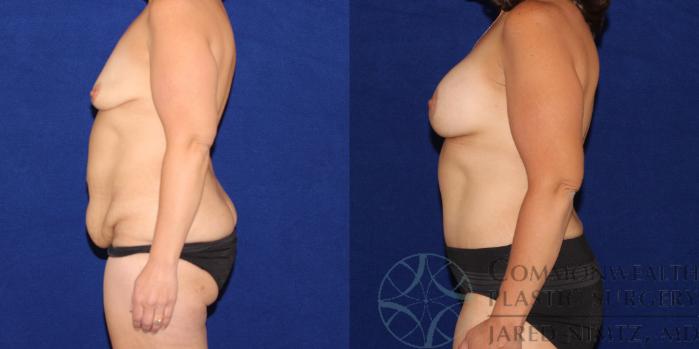 Before & After Tummy Tuck Case 79 View #3 View in Lexington & London, KY