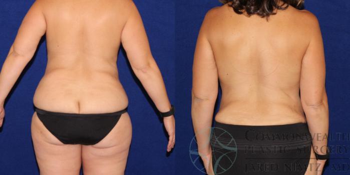 Before & After Breast Lift Case 79 View #4 View in Lexington & London, KY