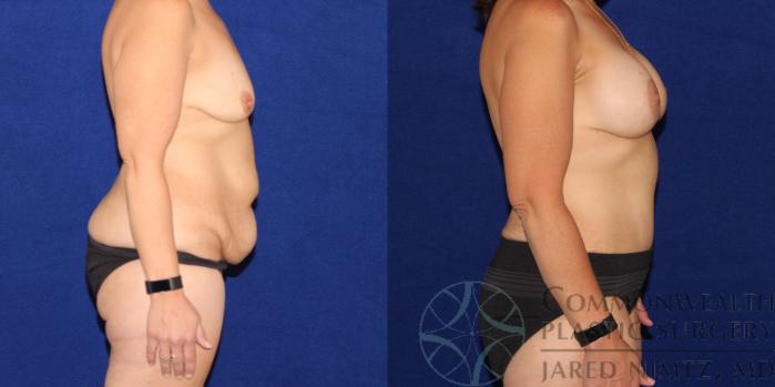Before & After Breast Augmentation Case 79 View #5 View in Lexington & London, KY