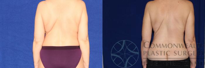 Before & After Liposuction Case 93 Back View in Lexington & London, KY