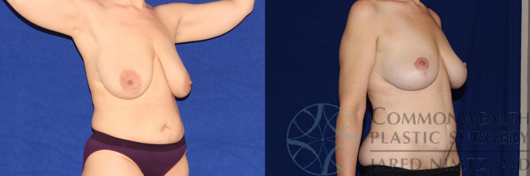 Before & After Mommy Makeover Case 93 Right Oblique View in Lexington & London, KY