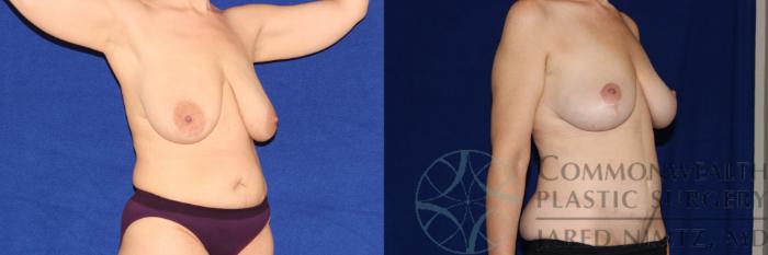Before & After Mommy Makeover Case 93 Right Oblique View in Lexington & London, KY