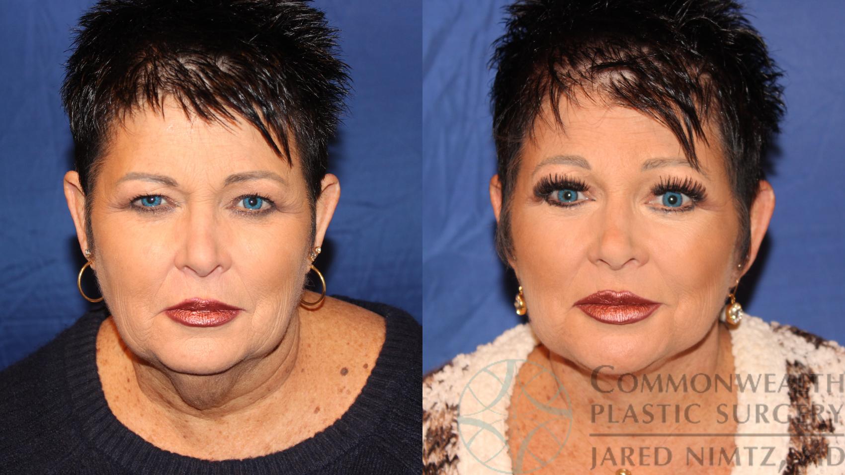 Before & After Neck Lift Case 109 Front View in Lexington & London, KY