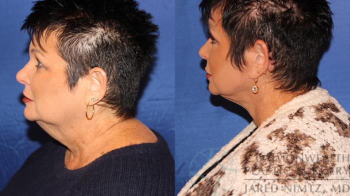 Before & After Neck Lift Case 109 Left Side View in Lexington & London, KY