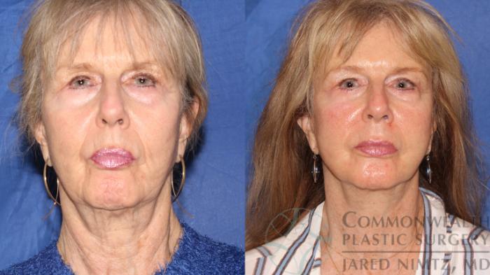 Before & After Neck Lift Case 116 Front View in Lexington & London, KY