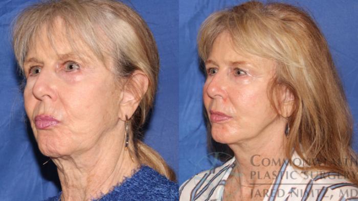 Neck Lift Before And After Pictures Case 116 Lexington And London Ky