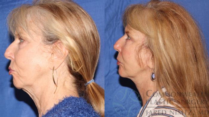 Before & After Neck Lift Case 116 Left Side View in Lexington & London, KY