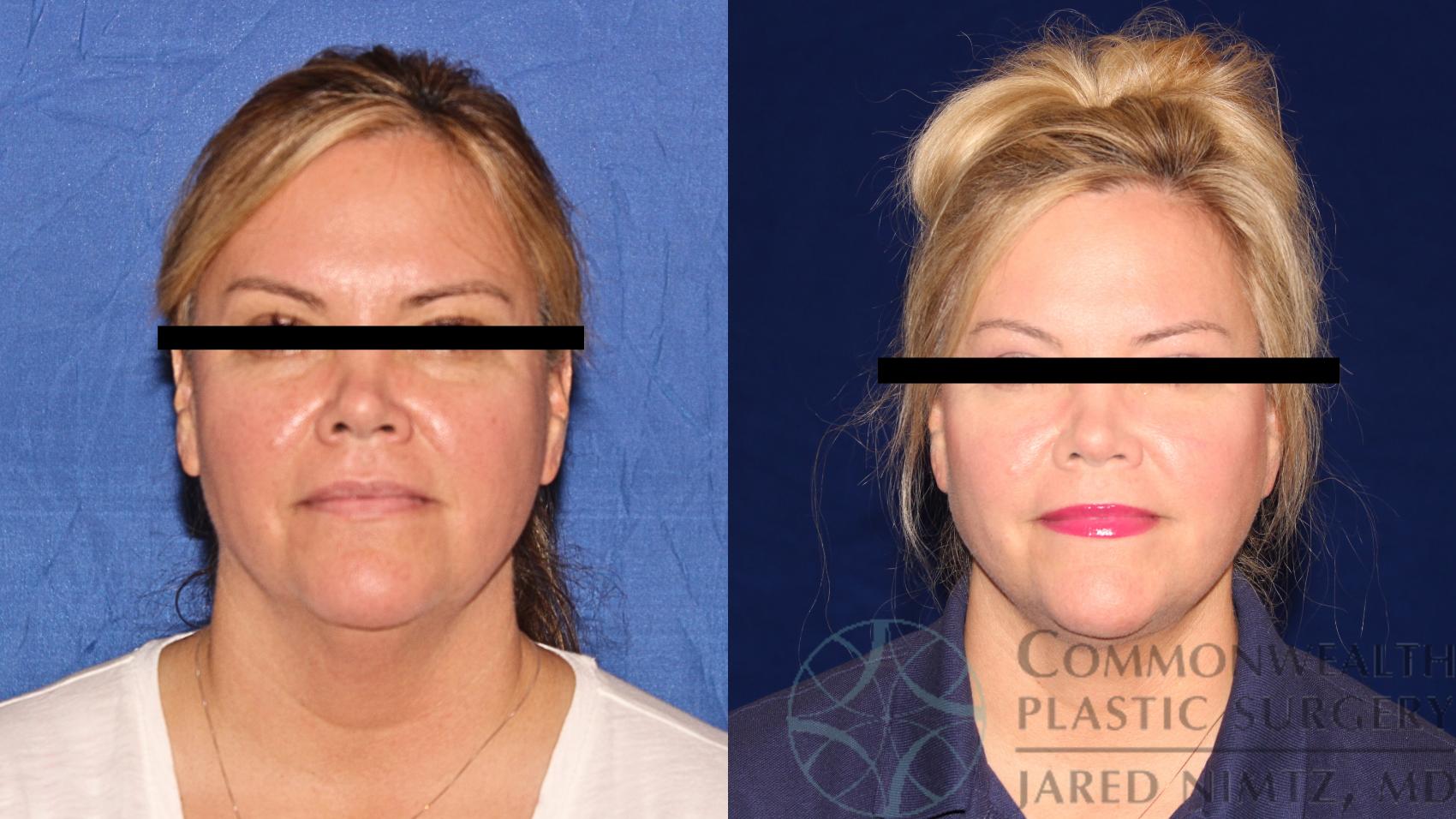 Before & After Neck Lift Case 117 Front View in Lexington & London, KY