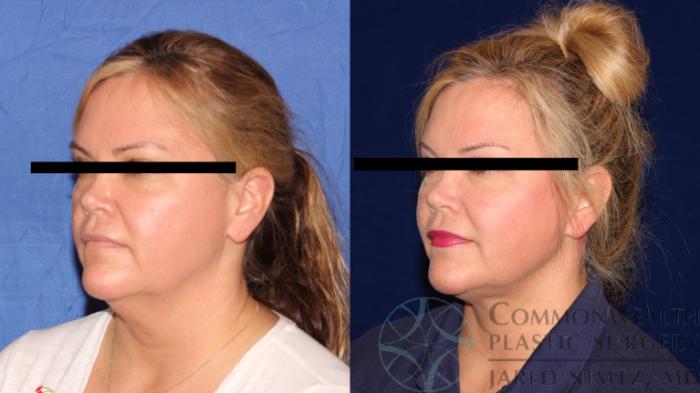 Before & After Facial Fat Grafting Case 117 Left Oblique View in Lexington & London, KY